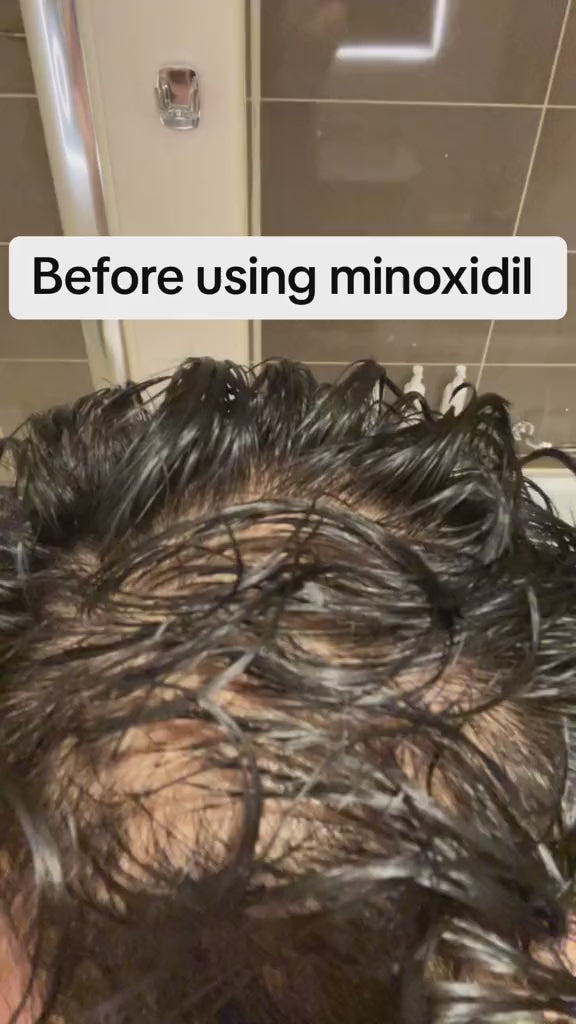 5% Extra Strength Hair Regrowth video